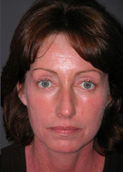 Mid Facelift - Patient 3 - Front - After